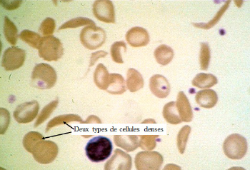 Hétérogénéité des globules rouges de patients drépanocytaires : coexistence d’hématies hyper denses et très peu déformables, falciformes ou non, et de globules rouges d’aspect normal. Copyright : AP-HP Henri Mondor.