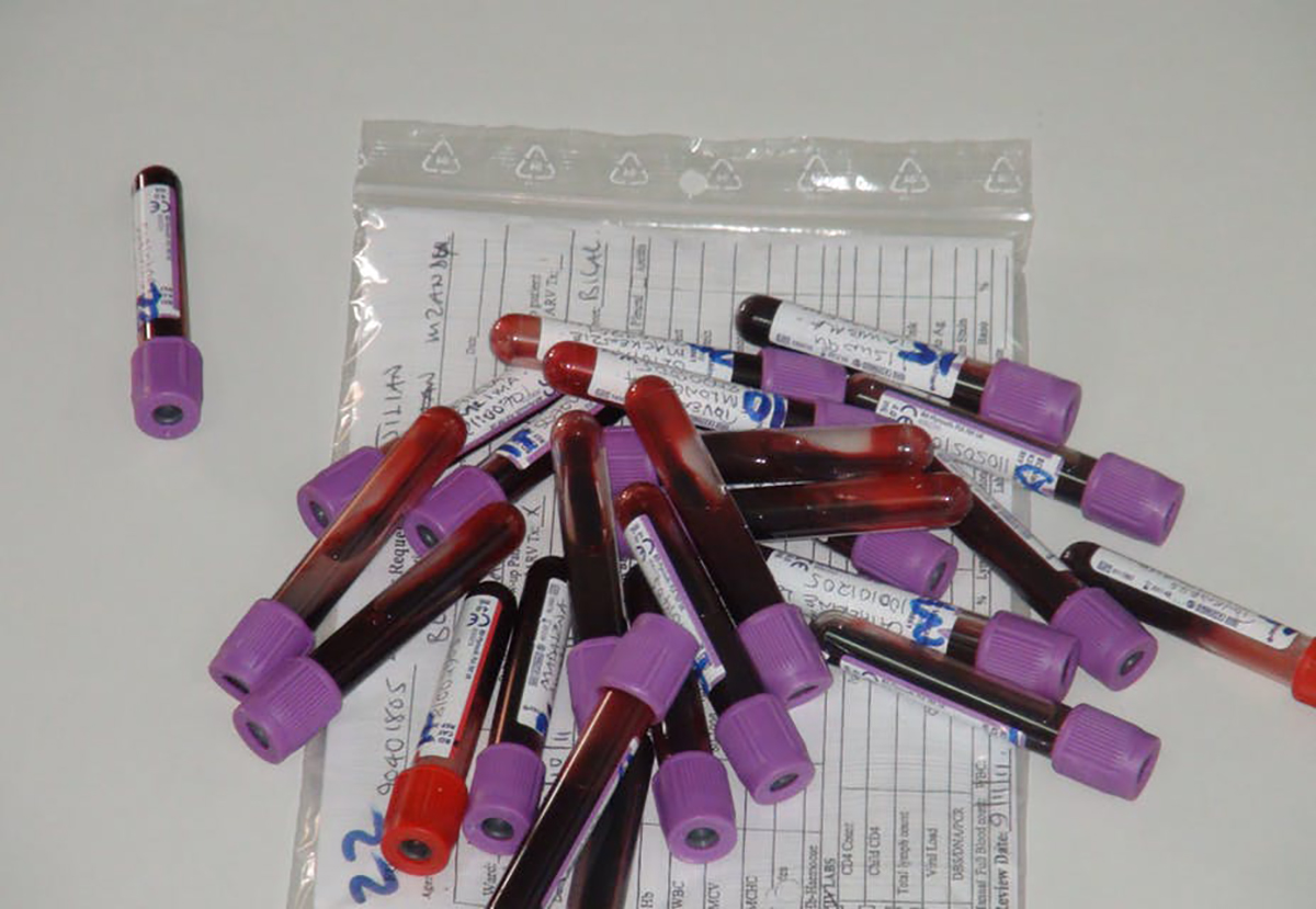 Echantillons de sang prélevés pour examen auprès de patients bénéficiant d'un traitement par antiviraux contre le VIH au Malawi, en 2011, dans un programme de Médecins sans frontières. Isabelle Merny/MSF, CC BY-NC-ND
