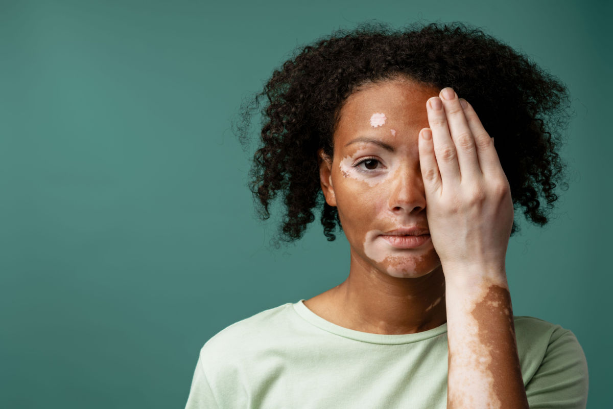 Vitiligo_UPEC_Shutterstock_2017926296